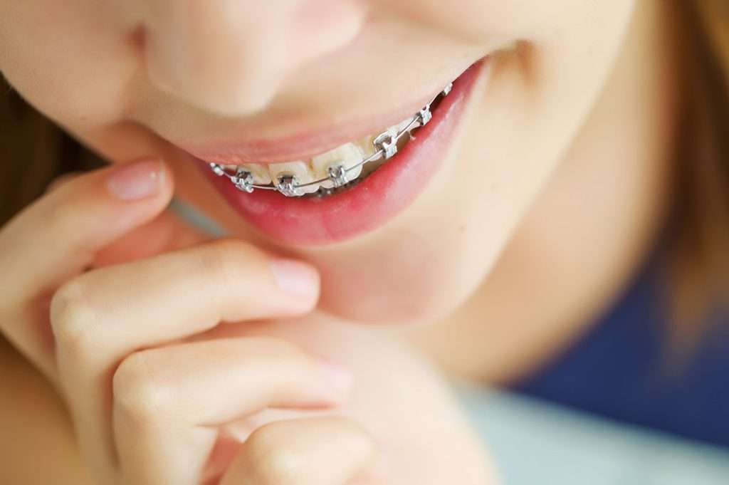 Close up shot of braces on a teen